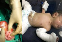 Photo of Baby Born “Pregnant” With Twin Brother Inside Him