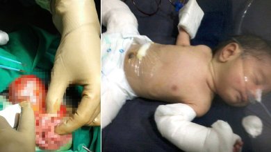 Photo of Baby Born “Pregnant” With Twin Brother Inside Him